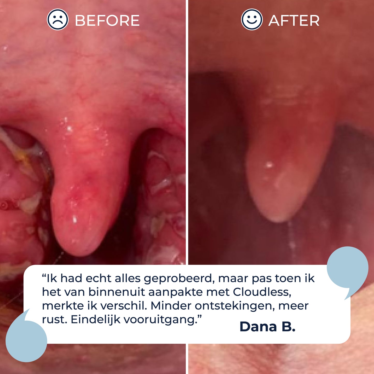 BreatheWays® Magnetisk Näsclip