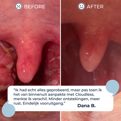 BreatheWays® Magnetisk Näsclip